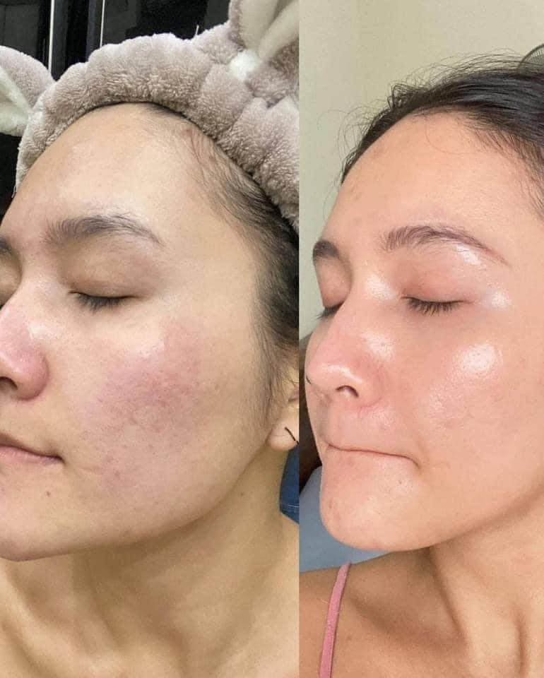 Da trước và sau khi xài Dung dịch BHA Obagi Clenziderm MD Pore Therapy 