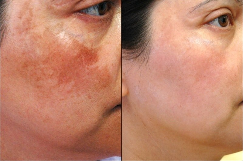 Khuôn mặt trước và sau khi bắn laser trị nám