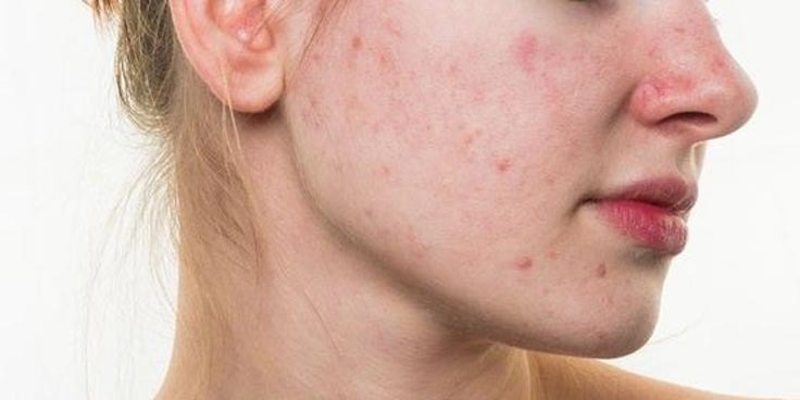 Eczema một trong những nguyên nhân khiến da ngứa
