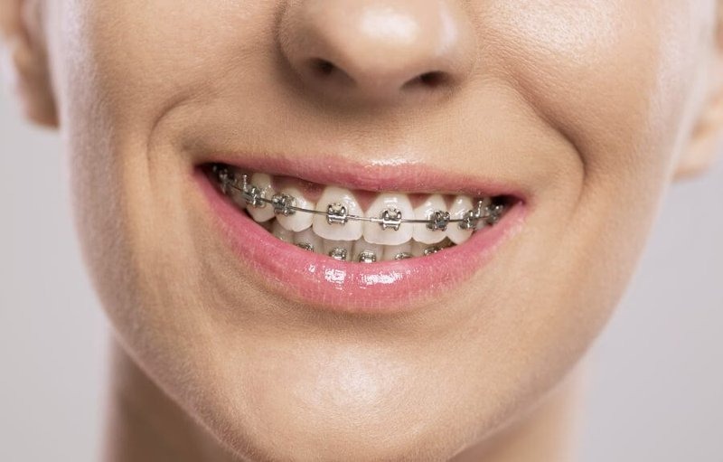 Quá trình niềng răng thẩm mỹ - Ảnh 3