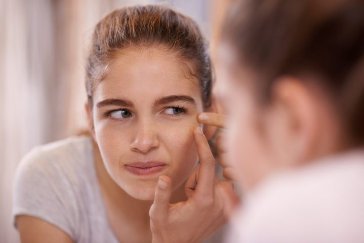 10 cách làm mặt nạ trị mụn tại nhà phù hợp với mọi làn da