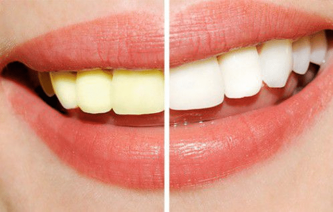 7 nguyên nhân gây vàng răng mà bạn không thể ngờ tới!