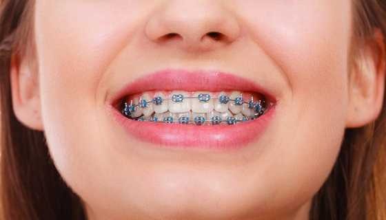 Niềng răng Giúp Cải thiện Giọng nói - Ảnh 5