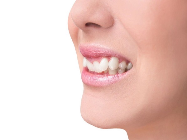 Nguyên nhân gây ra tình trạng răng khấp khểnh  - Ảnh 1