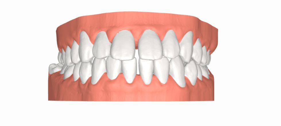 Nguyên nhân của răng khấp khểnh - Ảnh 1