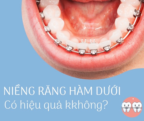 Làm thế nào về niềng răng chỉ trên hàm dưới? - Ảnh 2