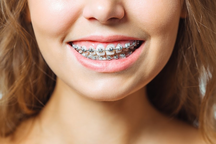 Niềng răng mắc cài kim loại có chi phí niềng răng rẻ nhất so với các phương pháp còn lại - Ảnh 2