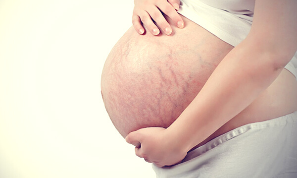 15 cách trị rạn da tại nhà hiệu quả nhất cho người tăng cân, mẹ bầu và mẹ sau sinh