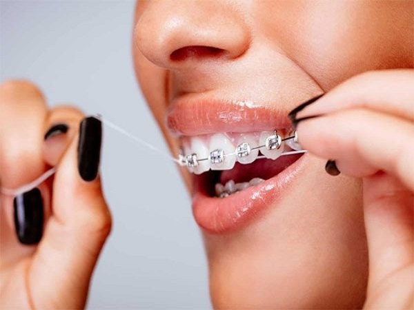Các cách chăm sóc răng miệng khi niềng răng bằng chải răng và chỉ nha khoa - Ảnh 2