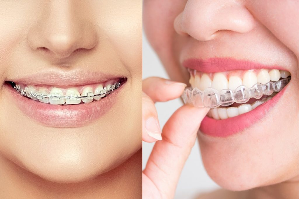 Điểm khác nhau giữa niềng răng trong suốt và niềng răng truyền thống - Ảnh 2