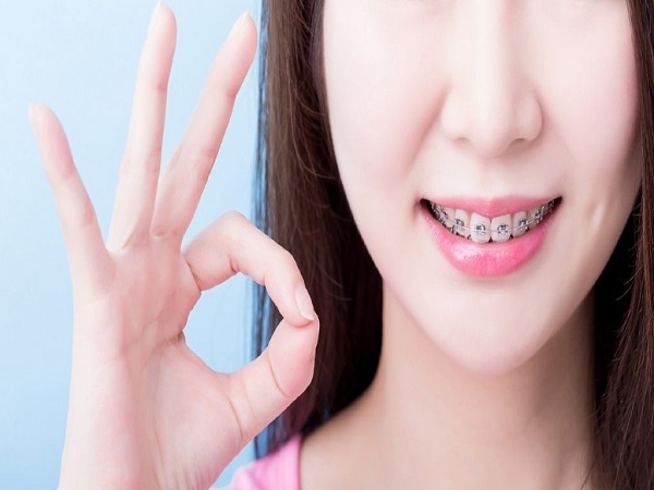 Sự khác biệt giữa niềng răng 1 hàm và niềng răng 2 hàm