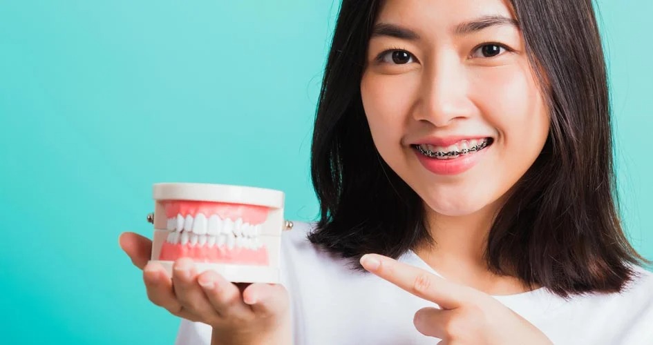 Các phương pháp niềng răng phổ biến & chi phí niềng răng mới nhất 2022