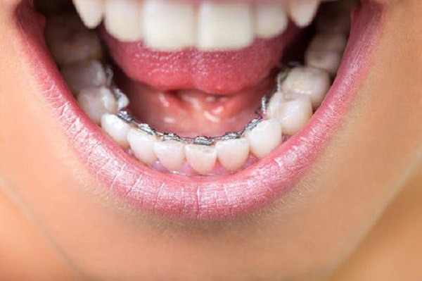 Niềng răng mắc cài mặt trong có chi phí niềng răng khá cao so với các phương pháp còn lại - Ảnh 3