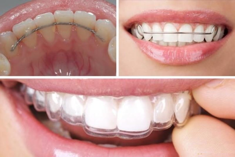 Cần đeo hàm duy trì bao lâu sau khi tháo niềng răng ?