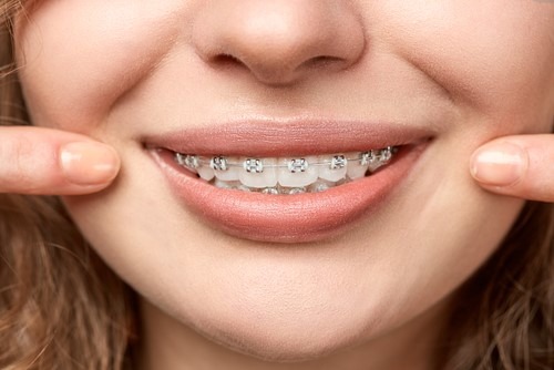 5 lợi ích của răng thẳng - Ảnh 2