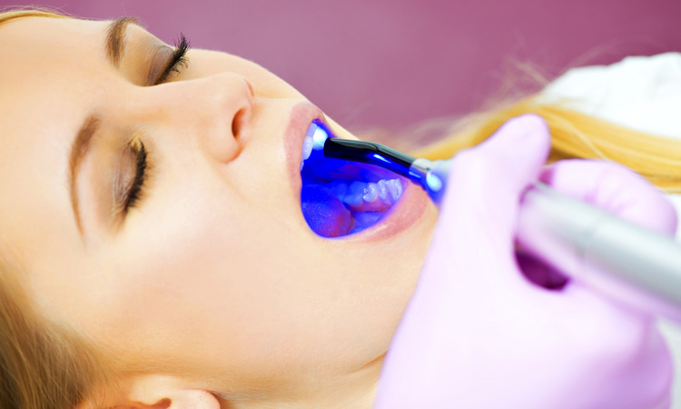 Laser whitening – làm trắng răng công nghệ cao có đáng để thử?