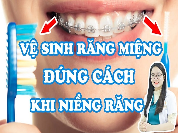Vệ sinh răng miệng đúng cách khi niềng răng - Ảnh 4