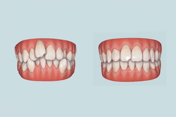 Hệ quả của tình trạng răng khấp khểnh là gì? - Ảnh 2