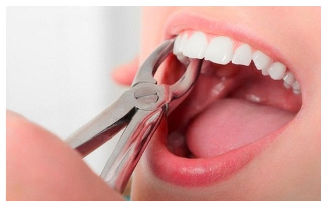 Bạn đã từng nghe những lời khẳng định rằng việc nhổ răng để niềng răng là sai? - Ảnh 4