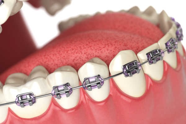 Niềng răng hàm dưới bằng phương pháp mắc cài kim loại - Ảnh 3