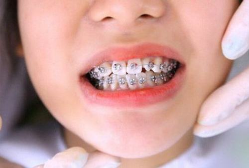 Răng hô là gì? Chi phí niềng răng hô nhẹ bao nhiêu?