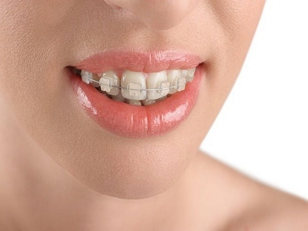 Mặt hạn chế của việc chỉ niềng răng ở răng trên hoặc răng dưới - Ảnh 4