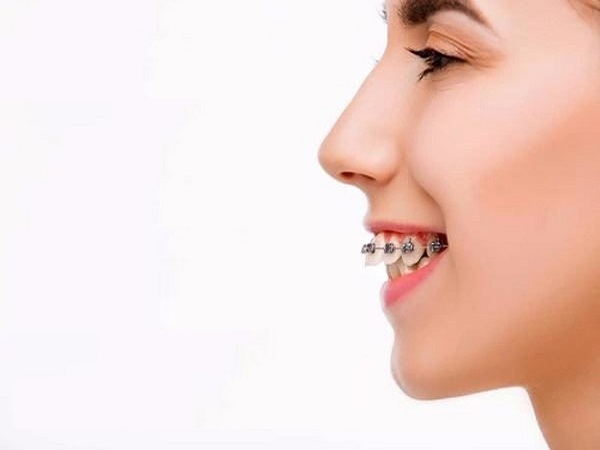 Phương pháp niềng răng hô hiệu quả - Ảnh 4