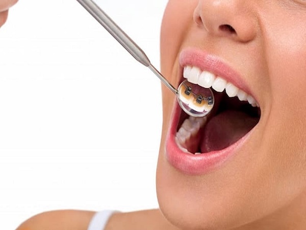Phương pháp niềng răng mắc cài mặt trong - Ảnh 3