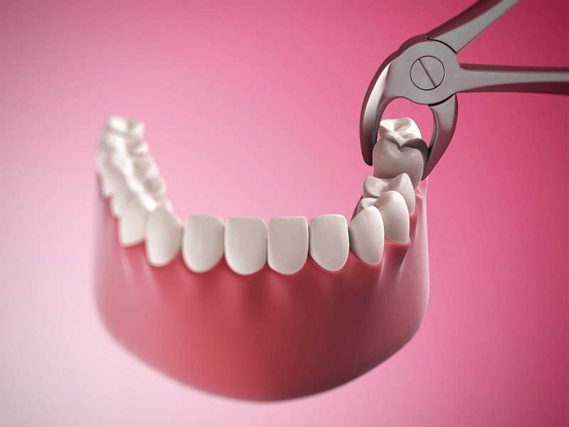 Trong những tình huống nào người ta sẽ cân nhắc hoặc lựa chọn nhổ răng để điều trị chỉnh nha? - Ảnh 2