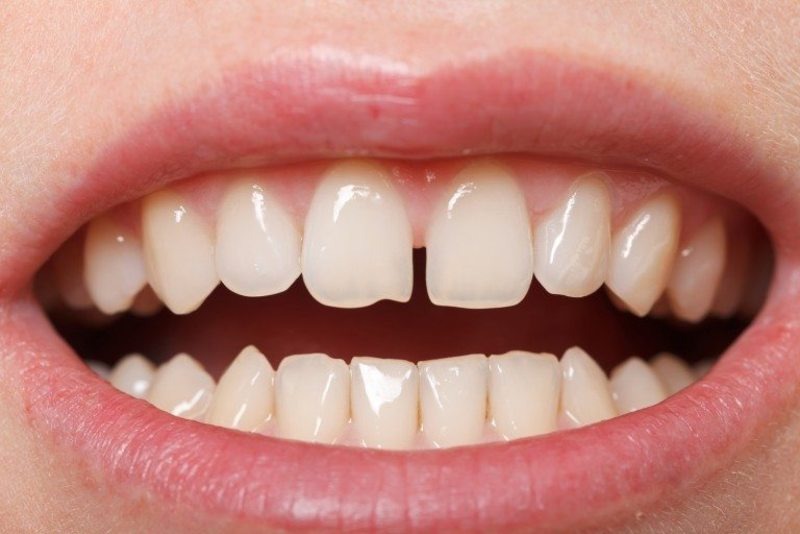 Nguyên nhân của răng thưa là gì? - Ảnh 2