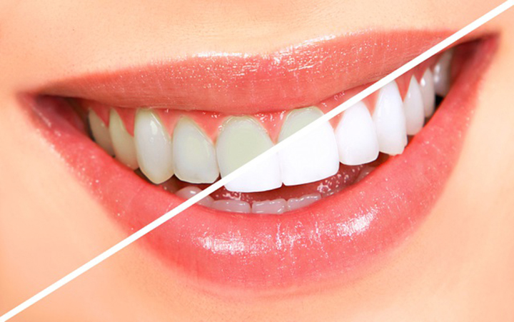 TOP 10 Cách tẩy trắng răng siêu hiệu quả bạn không nên bỏ lỡ