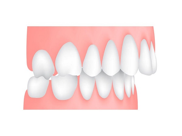 Dấu hiệu nhận biết tình trạng răng hô - Ảnh 1