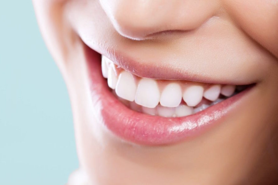 Răng của bạn có đủ tiêu chuẩn để tẩy trắng?