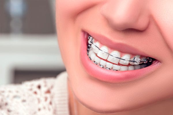 Niềng răng không nhổ có thực sự hiệu quả?