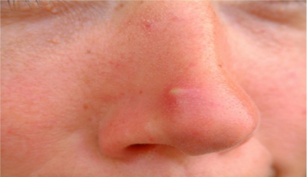 Mụn mủ có thể dẫn tới tình trạng sẹo lõm trên khuôn mặt