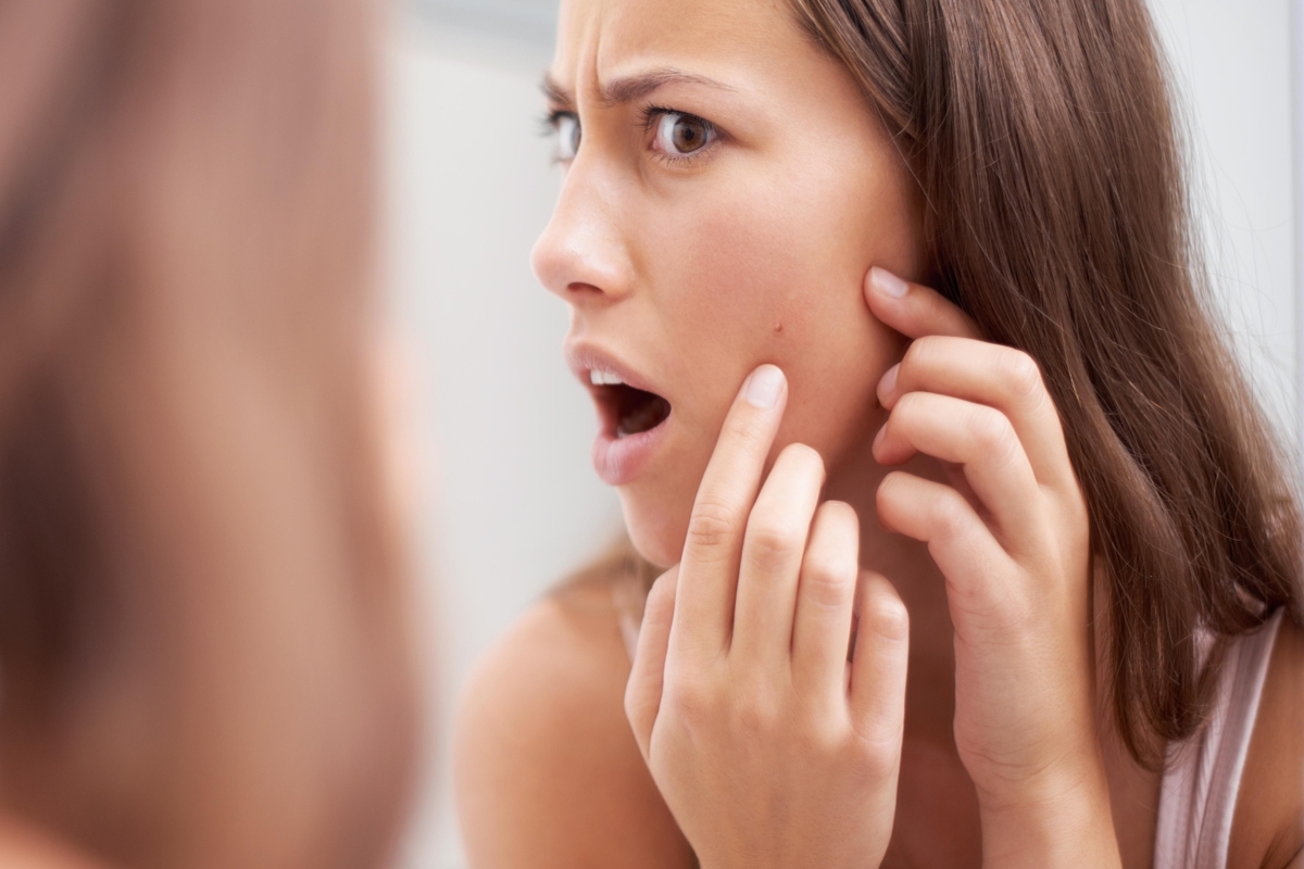 9 nguyên nhân gây mụn trên mặt và cách điều trị chuẩn khoa học