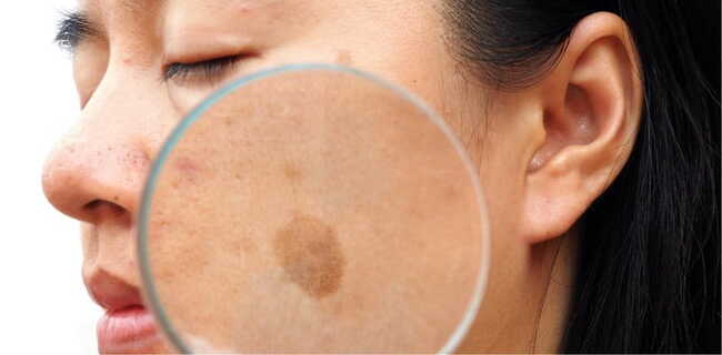 Nám da là tình trạng rối loạn sắc tố, khiến da xuất hiện các mảng màu nâu hoặc xám