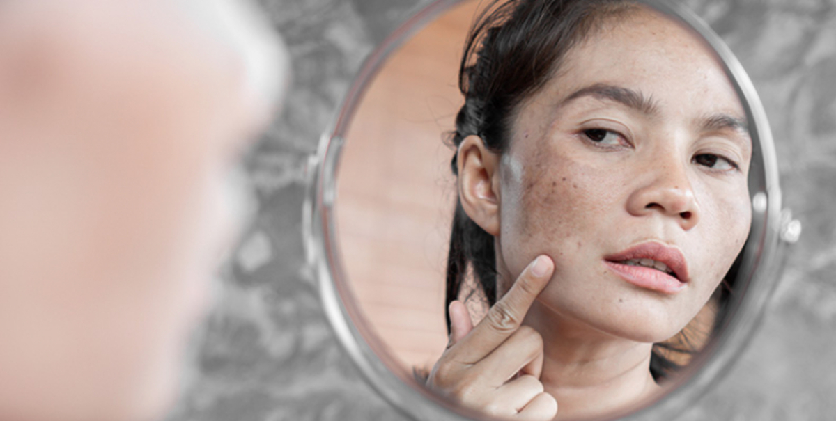 8 nguyên nhân gây nám da phổ biến ở phụ nữ