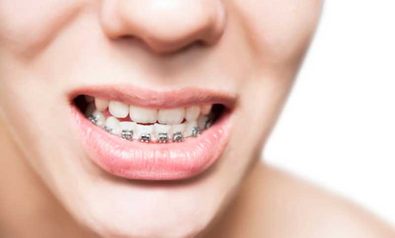 Niềng răng giai đoạn nào đau nhất bạn phải trải qua?