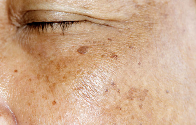 Da xuất hiện các đốm đồi mồi do rối loạn sắc tố da