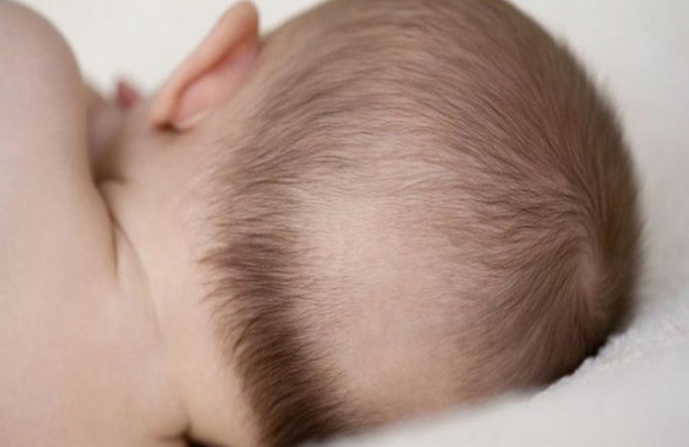 Rụng tóc vành khăn là gì? Dấu hiệu và cách điều trị hiệu quả cho bé