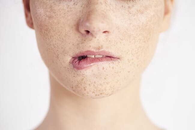 Nám, tàn nhang là một trong những biểu hiện rõ nét nhất của tình trạng tăng sắc tố da