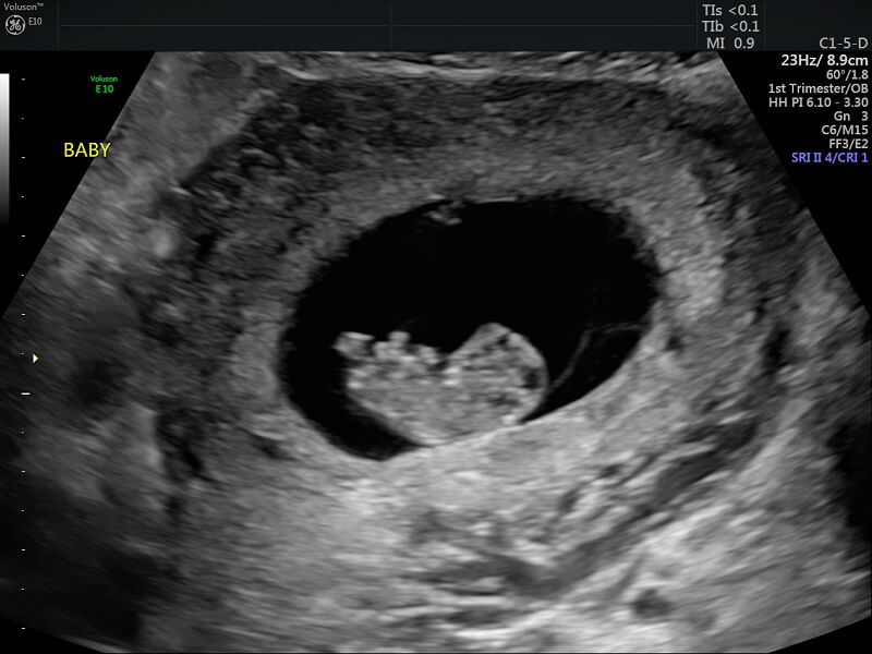  Hình ảnh siêu âm thai nhi 9 tuần tuổi 