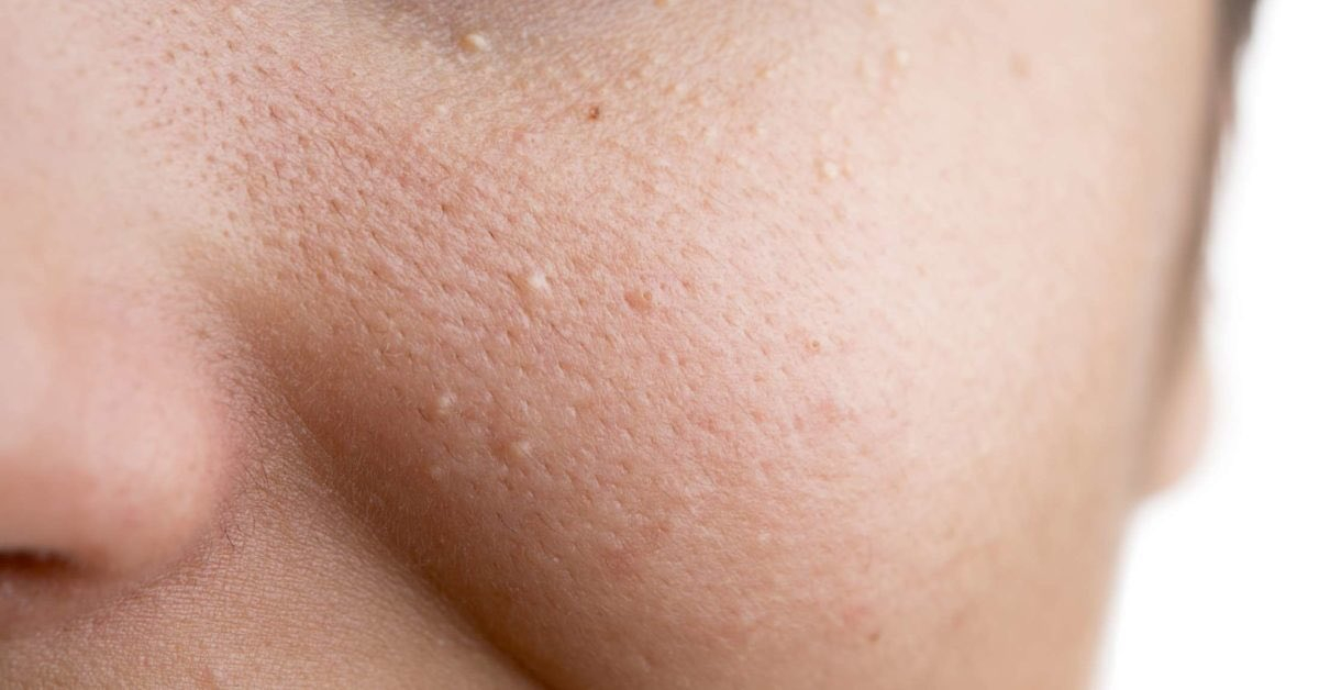 10 cách trị mụn ẩn dưới da hiệu quả được các chuyên gia da liễu khuyên dùng