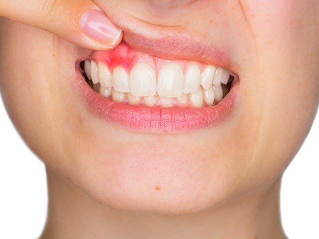 Tình trạng viêm lợi trước khi niềng răng