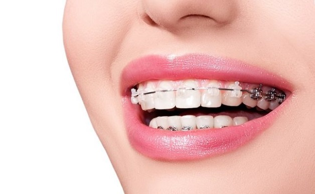 Hàm duy trì sau niềng răng là gì? Vì sao phải sử dụng chúng?