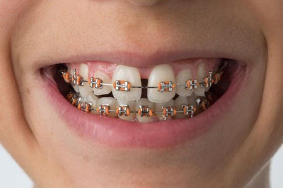Bạn cần chuẩn bị gì trước khi đi niềng răng? 