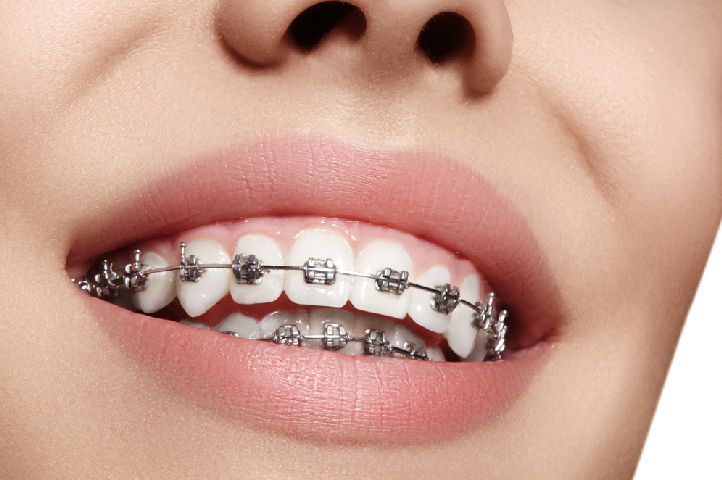 Niềng răng mắc cài kim loại có đau không?