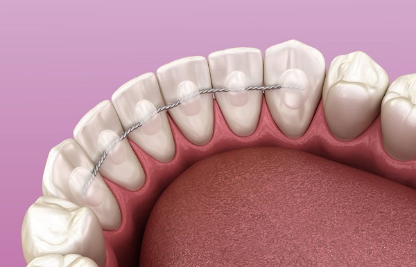 Tìm hiểu về hàm duy trì sau niềng răng | Thetips