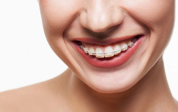 Vì sao niềng răng sứ trở nên phổ biến? Ưu và nhược điểm